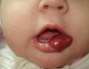 1А. Капилярная гемангиома красной каймы губы до лазерного склерозирования