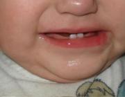 1Б. Капилярная гемангиома красной каймы губы после лазерного склерозирования