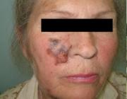 Меланома кожи (толщина по Бреслоу 8 мм). На правом снимке пациентка через 2 года после ФДТ.