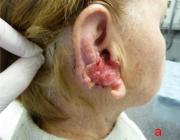 Железистый рак с поражением наружного ушного прохода.