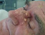 1А. Множественные эпидермоидные кисты кожи носа до лазерной коагуляции.