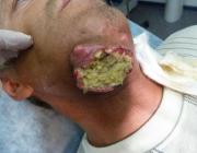 Плоскоклеточный рак. Опухоль проросла на поверхность нижней челюсти. Зловонный распад.