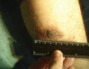 3А. Крупный врожденный невус на голени до лазерной деструкции