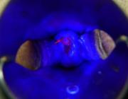 Флуоресцентная диагностика рака шейки матки. В ультрафиолетовом свете после внутривенного введения димегина. Розовое свечение выявляет злокачественные очаги (отмечено стрелкой)