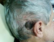 Крупная себорейная кератома на волосистой части головы, поверхность бугристая из-за роговых кист. В онкодиспансере пациенту был ошибочно поставлен диагноз меланома.