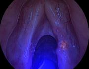 Эндоскопическая флюоресцентная диагностика (фотосенсибилизатор димегин, источник света 405 нм). Пурпурное свечение очага рака.