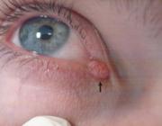 Кондилома на конъюнктиве глаза