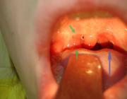 Гипертрофия миндалин 3степени. Увеличенная миндалина выделена зелеными стрелками, на противоположной стороне миндалина только что удалена лазером, синяя стрелка направлена на небную нишу.