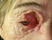 Базальноклеточный рак, рецидив после лучевого и хирургического лечения опухоли в области медиального угла глаза