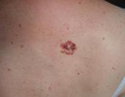 Лентиго-меланома кожи спины (инвазия по Кларку III). Малозаметный рубчик на месте опухоли через 7 лет после проведения фотодинамической терапии.