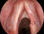 Эндоскопическая картина рака гортани возникшего на фоне папилломатоза (поражение голосовой связки)