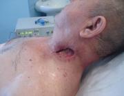 рана на шее после удаления метастаза лазером
