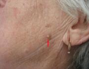 Актинический кератоз кожи лица (красная стрелка)