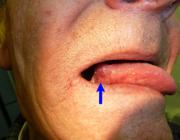 плоскоклеточный рак на боковой поверхности языка (отмечен стрелкой)
