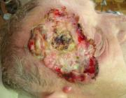 Последствия лучевого лечения (рентгено и гамматерапия) плоскоклеточного рака кожи (лучевой некроз лобной кости, продолженный рост опухоли, внутрикожный метастаз)