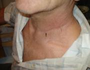 нормотрофический рубец после хирургического удаления липомы в области шеи (отмечен стрелкой)