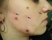 Пациентка с множественными врожденными невусами кожи лица с растущими из них терминальными волосками. Стрелками отмечены участки кожи, где невусы две недели назад были удалены лазером