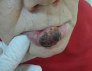 Экзофитный плоскоклеточный рак нижней губы (поздняя стадия, метастазы в подчелюстные лимфоузлы)