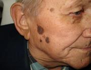 Множественные себорейные кератомы кожи лица