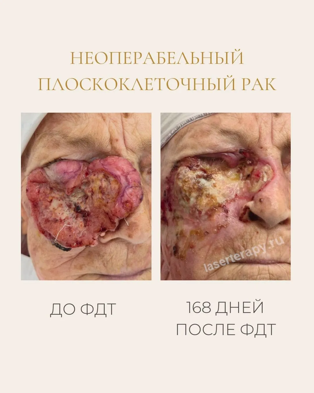 Неоперабельный плоскоклеточный рак у пациентки 1941 года рождения.