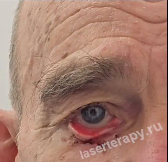 Базалиома века: классическая хирургия здесь часто бессильна.
