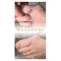АКРАЛЬНАЯ МЕЛАНОМА. АМПУТАЦИЯ ИЛИ ВОЗМОЖНОСТЬ СОХРАНИТЬ СТОПУ? АКРАЛЬНАЯ МЕЛАНОМА. АМПУТАЦИЯ ИЛИ ВОЗМОЖНОСТЬ СОХРАНИТЬ СТОПУ?