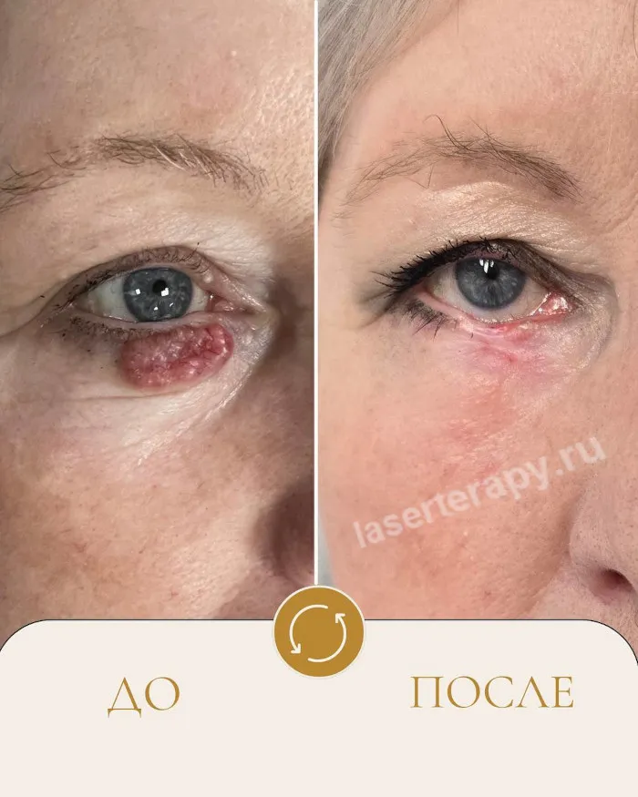 Лечение базальноклеточного рака кожи на веке