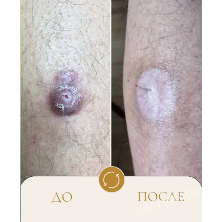 Базалиома голени.  