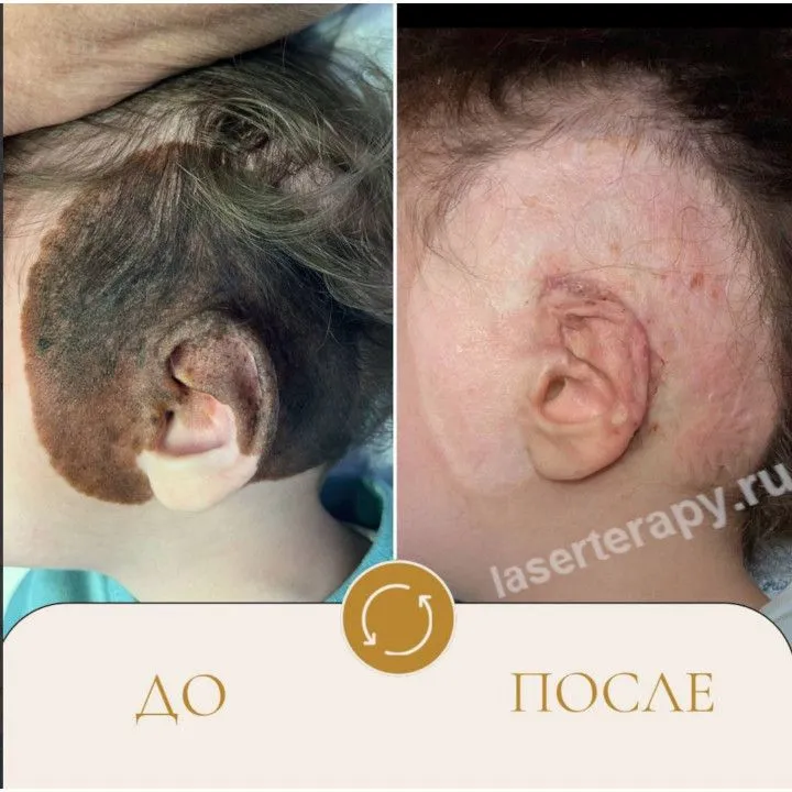 Удалён гигантский врожденный невус при нейрокожном меланозе.
