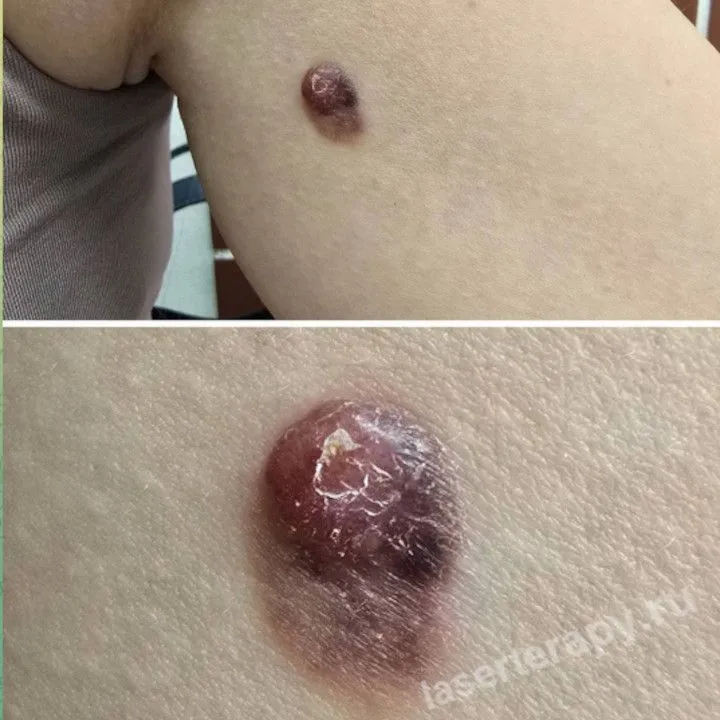 Меланома на коже плеча