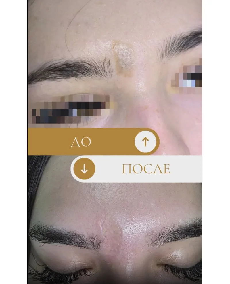 ФДТ меланоцитарных невусов