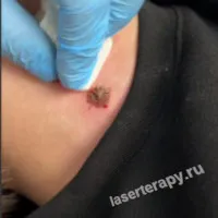 Множественные меланоцитарные невусы