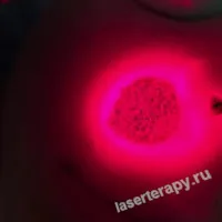Меланоцитарный невус