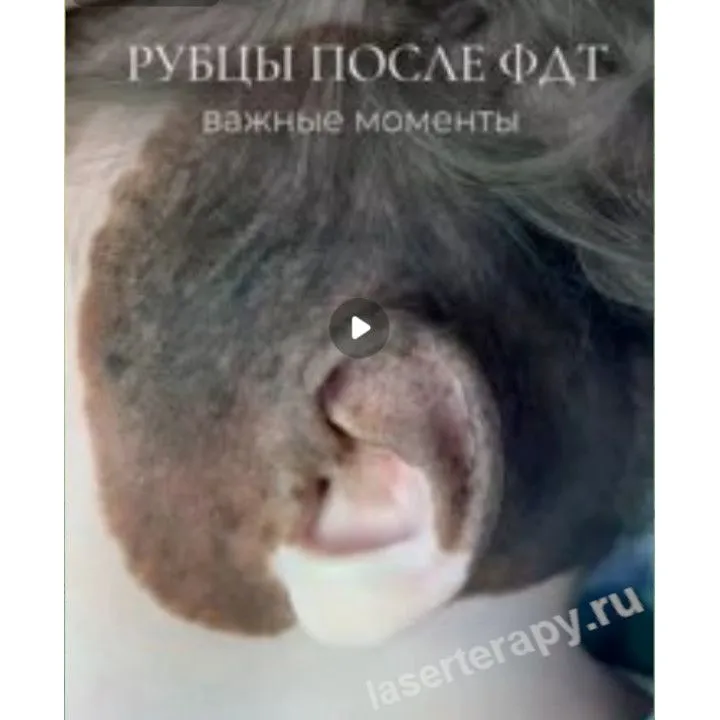 Рубцы после ФДТ