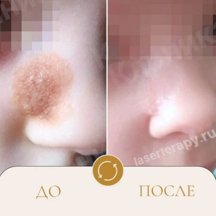 Как удалить опасный невус в сложном месте?
