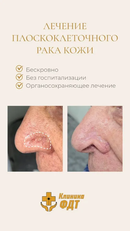 Лечение плоскоклеточного рака кожи