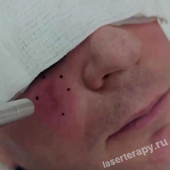 ФДТ при базалиоме — это лучшее решение на сегодняшний день! 
